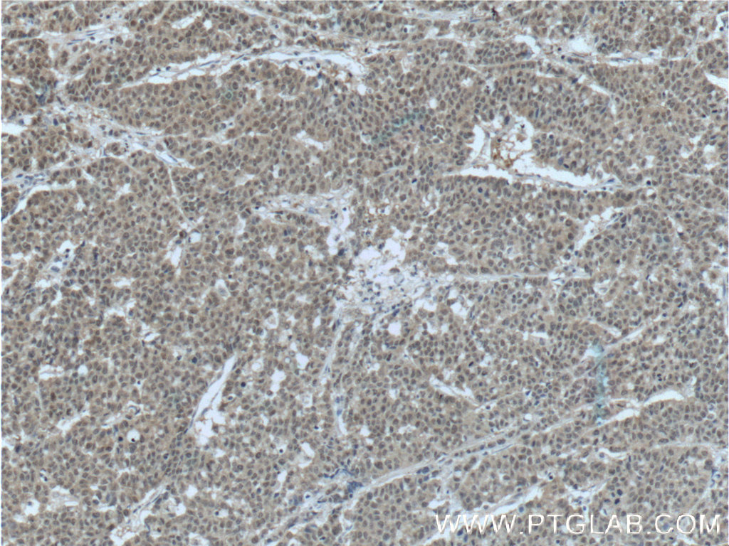 Immunohistochemistry (IHC) staining of human colon cancer tissue using FKBP52 Monoclonal antibody (66040-1-Ig)