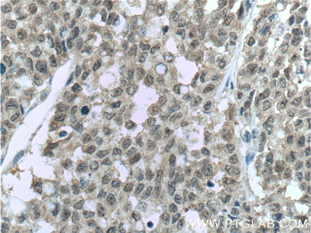 Immunohistochemistry (IHC) staining of human colon cancer tissue using FKBP52 Monoclonal antibody (66040-1-Ig)