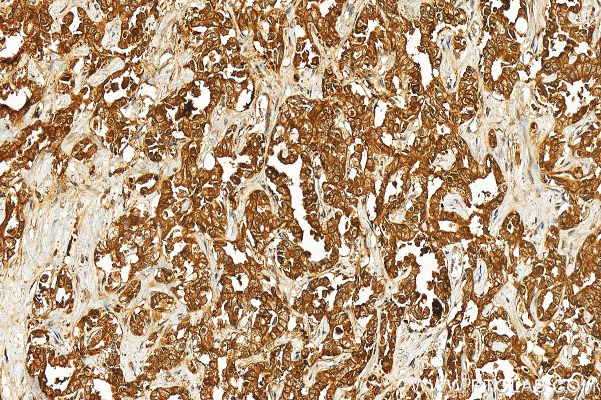 Immunohistochemistry (IHC) staining of human intrahepatic cholangiocarcinoma tissue using FLCN Polyclonal antibody (11236-2-AP)