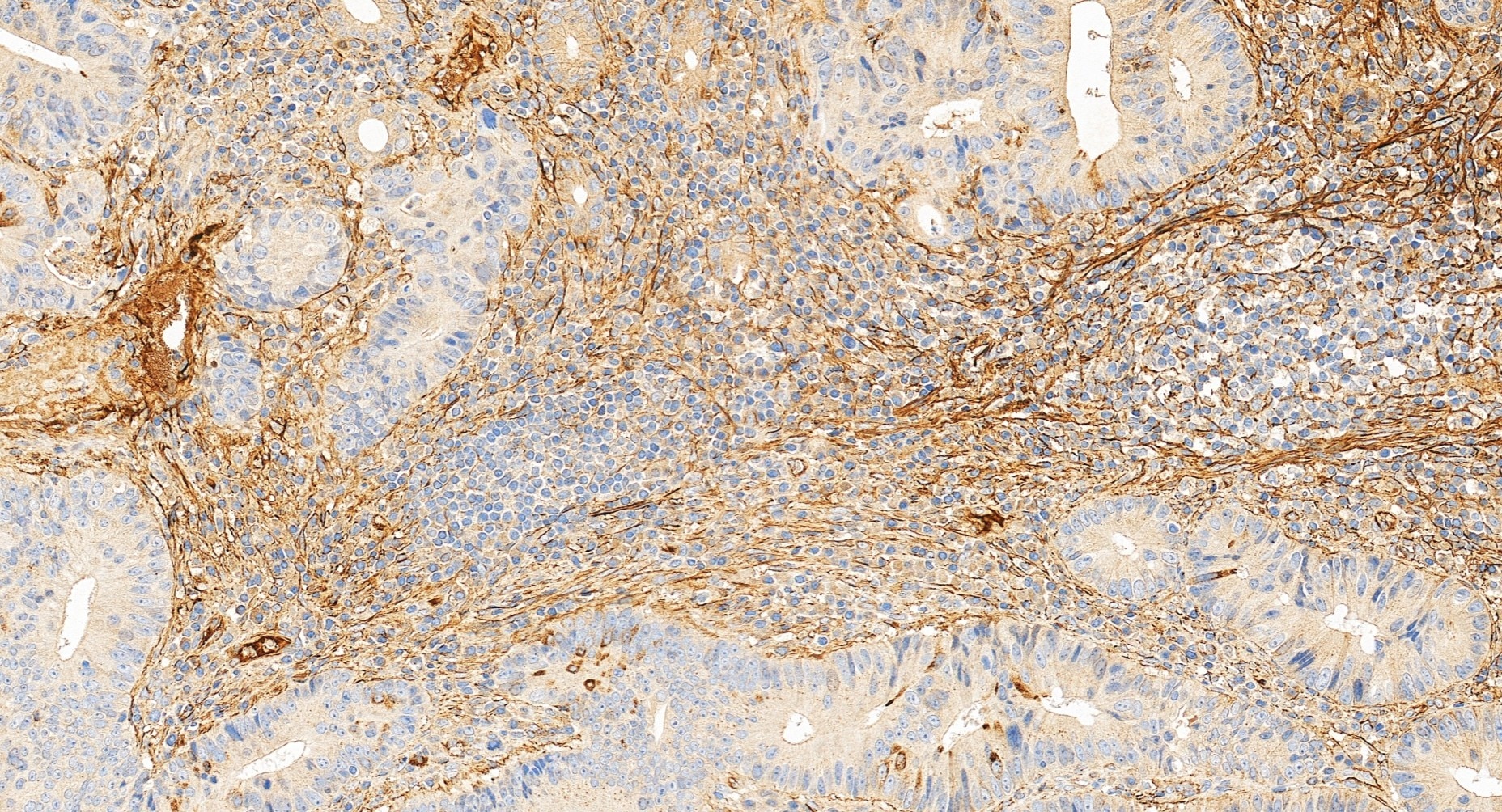 Immunohistochemistry (IHC) staining of human colon cancer tissue using Fibronectin Polyclonal antibody (15613-1-AP)