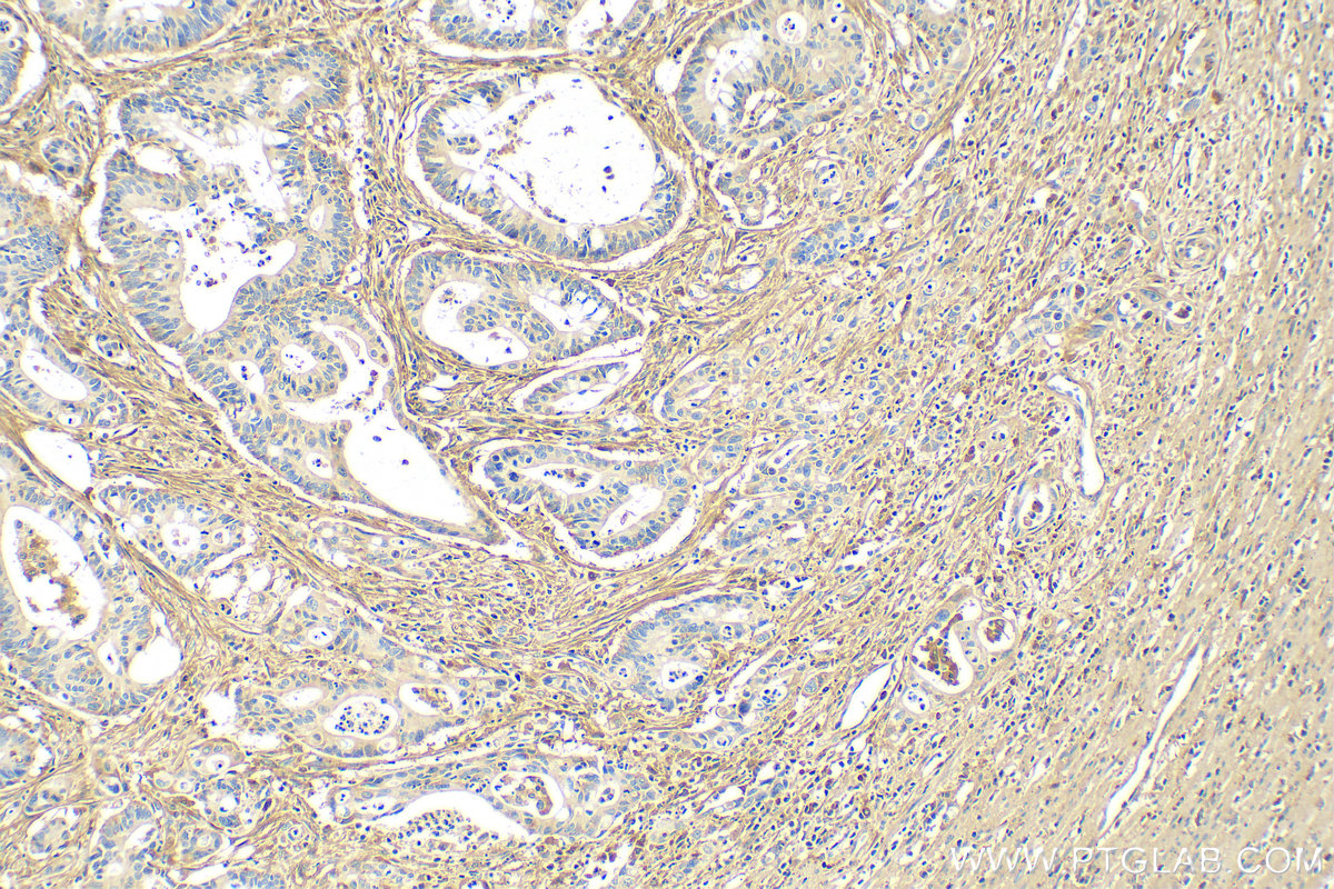 Immunohistochemistry (IHC) staining of human colon cancer tissue using Fibronectin Monoclonal antibody (66042-1-Ig)