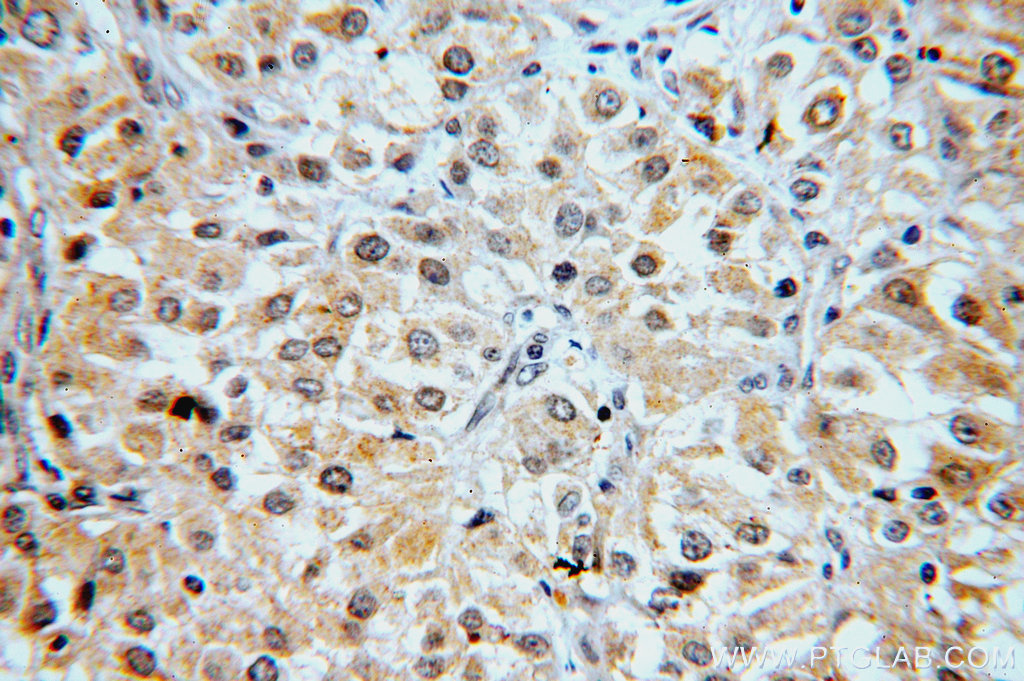 Immunohistochemistry (IHC) staining of human renal cell carcinoma tissue using FNIP1 Polyclonal antibody (19847-1-AP)