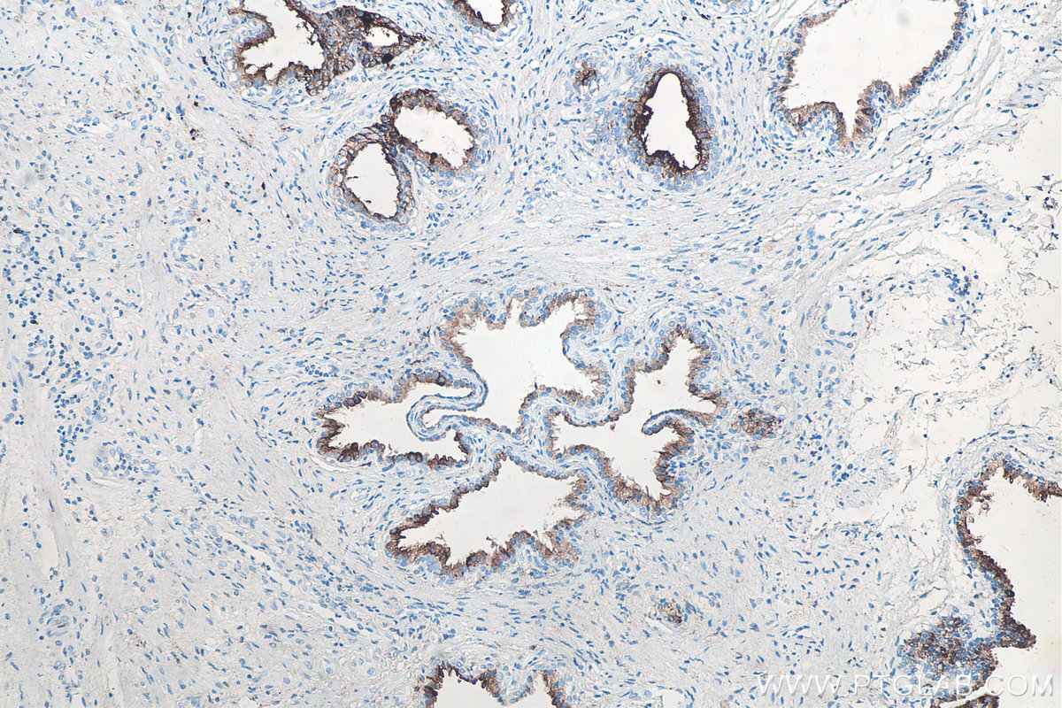 Immunohistochemistry (IHC) staining of human prostate cancer tissue using PSMA/GCPII Monoclonal antibody (66678-1-Ig)