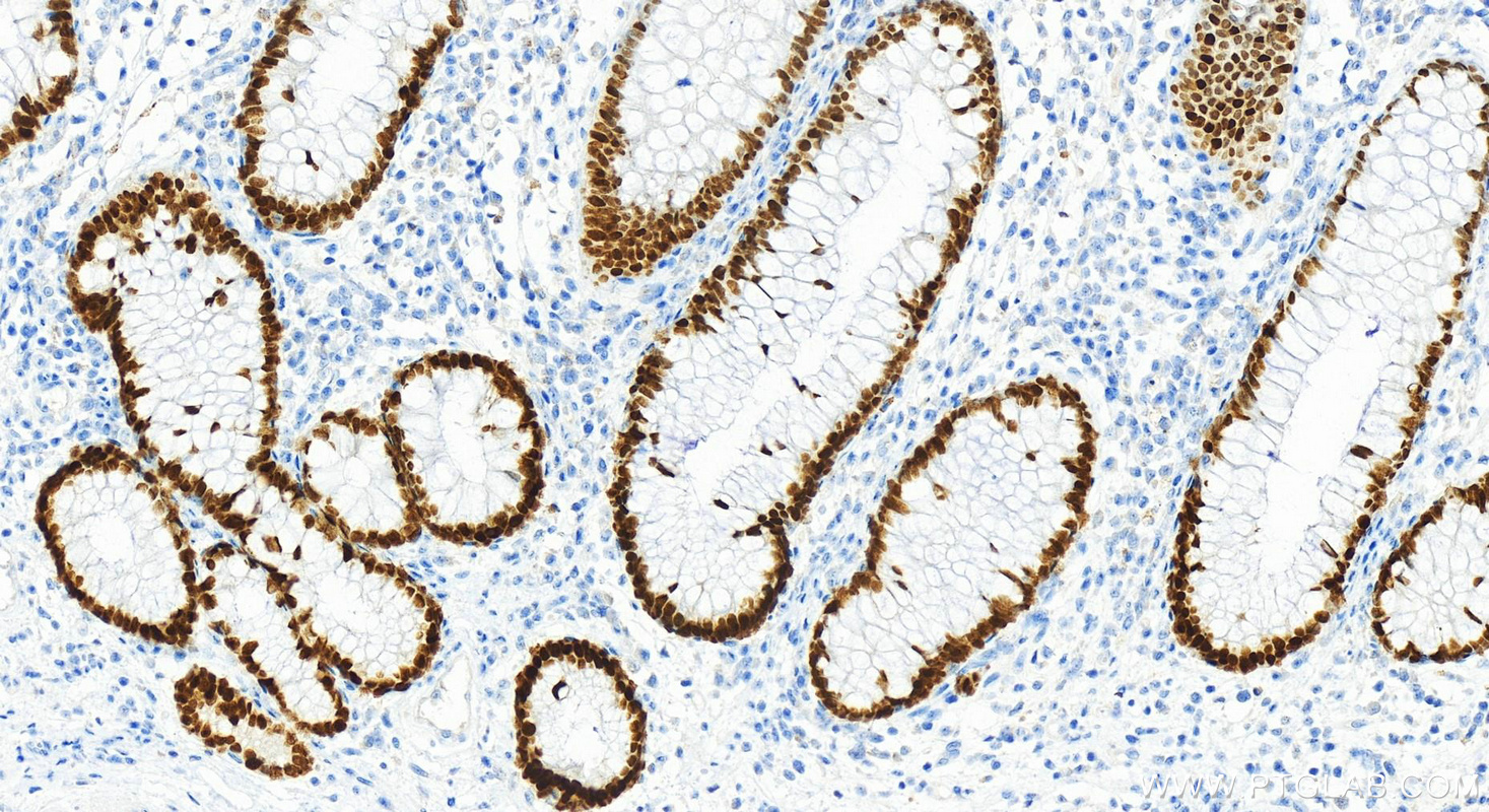 Immunohistochemistry (IHC) staining of human colon cancer tissue using FOXA2 Polyclonal antibody (22474-1-AP)