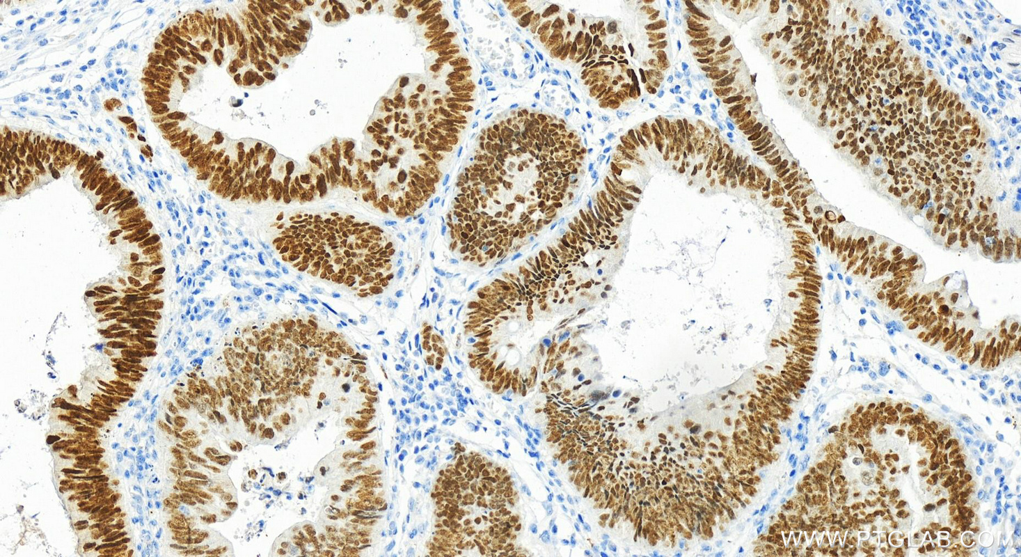 Immunohistochemistry (IHC) staining of human colon cancer tissue using FOXA2 Polyclonal antibody (22474-1-AP)