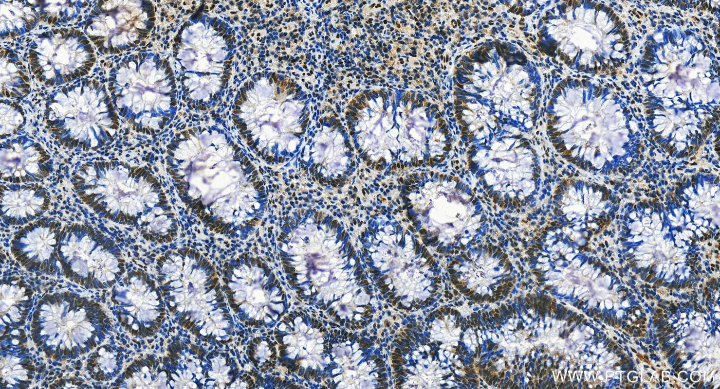 Immunohistochemistry (IHC) staining of human colon cancer tissue using FOXK1 Polyclonal antibody (29338-1-AP)