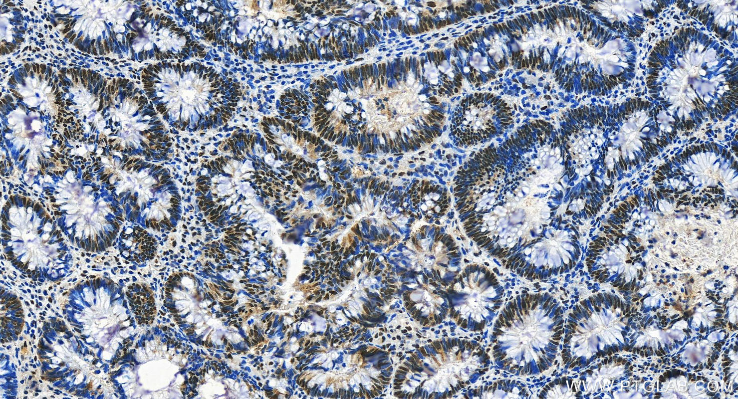 Immunohistochemistry (IHC) staining of human colon cancer tissue using FOXK1 Polyclonal antibody (29338-1-AP)