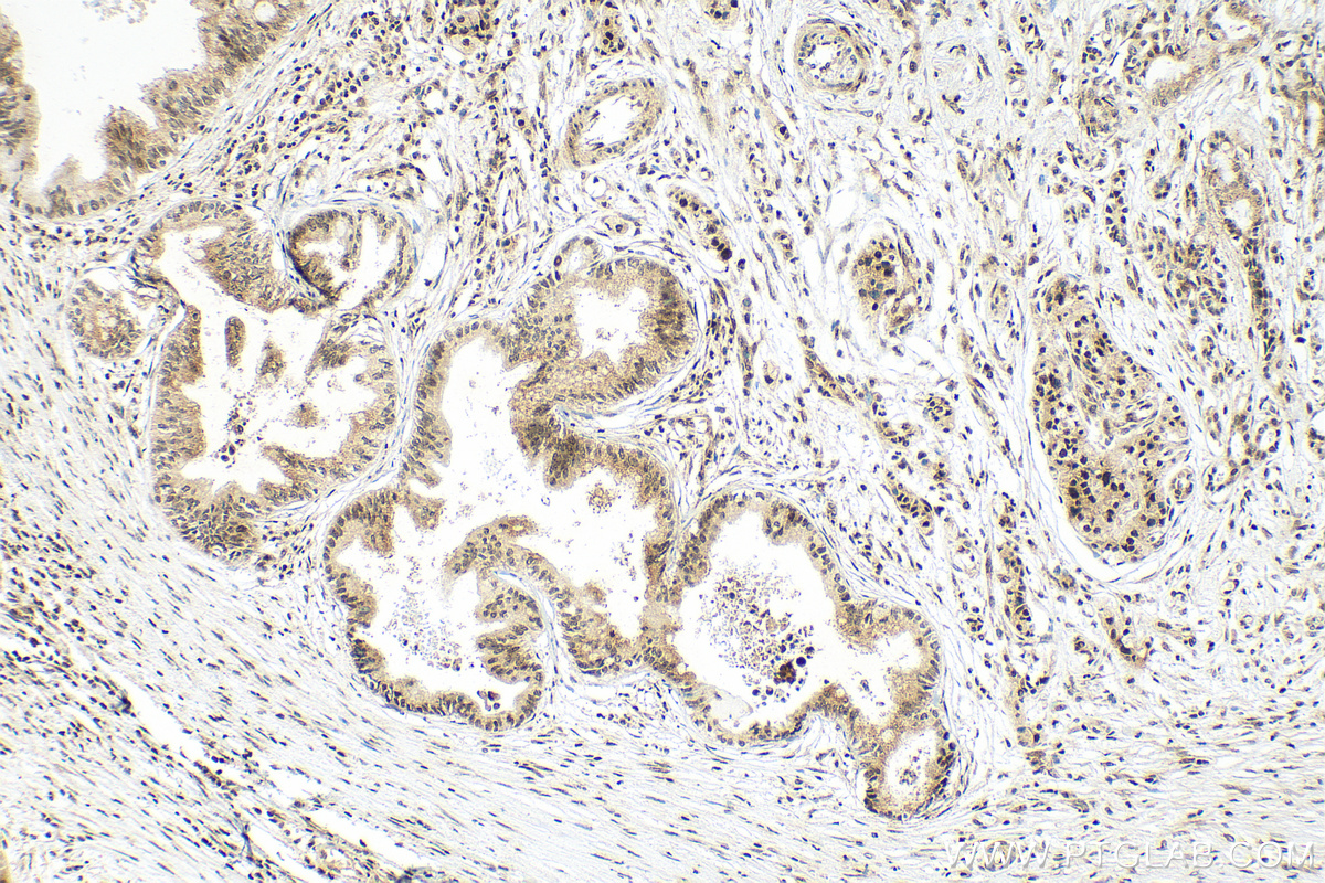 Immunohistochemistry (IHC) staining of human pancreas cancer tissue using FOXO1 Recombinant antibody (82997-1-RR)