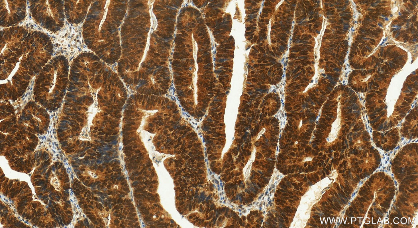 Immunohistochemistry (IHC) staining of human colon cancer tissue using FOXO3A Polyclonal antibody (10849-1-AP)