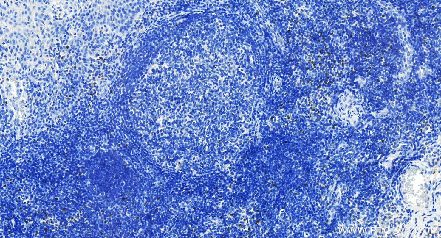 Immunohistochemistry (IHC) staining of human tonsillitis tissue using FOXP3 Polyclonal antibody (22228-1-AP)