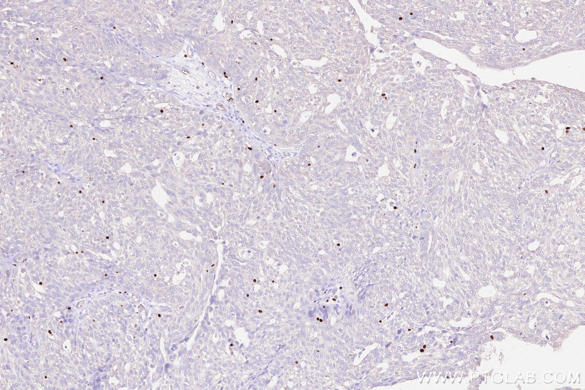 Immunohistochemistry (IHC) staining of human ovary cancer tissue using FOXP3 Monoclonal antibody (68803-2-Ig)