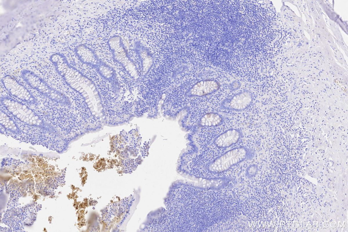 Immunohistochemistry (IHC) staining of human appendicitis tissue using FOXP3 Monoclonal antibody (68803-2-Ig)