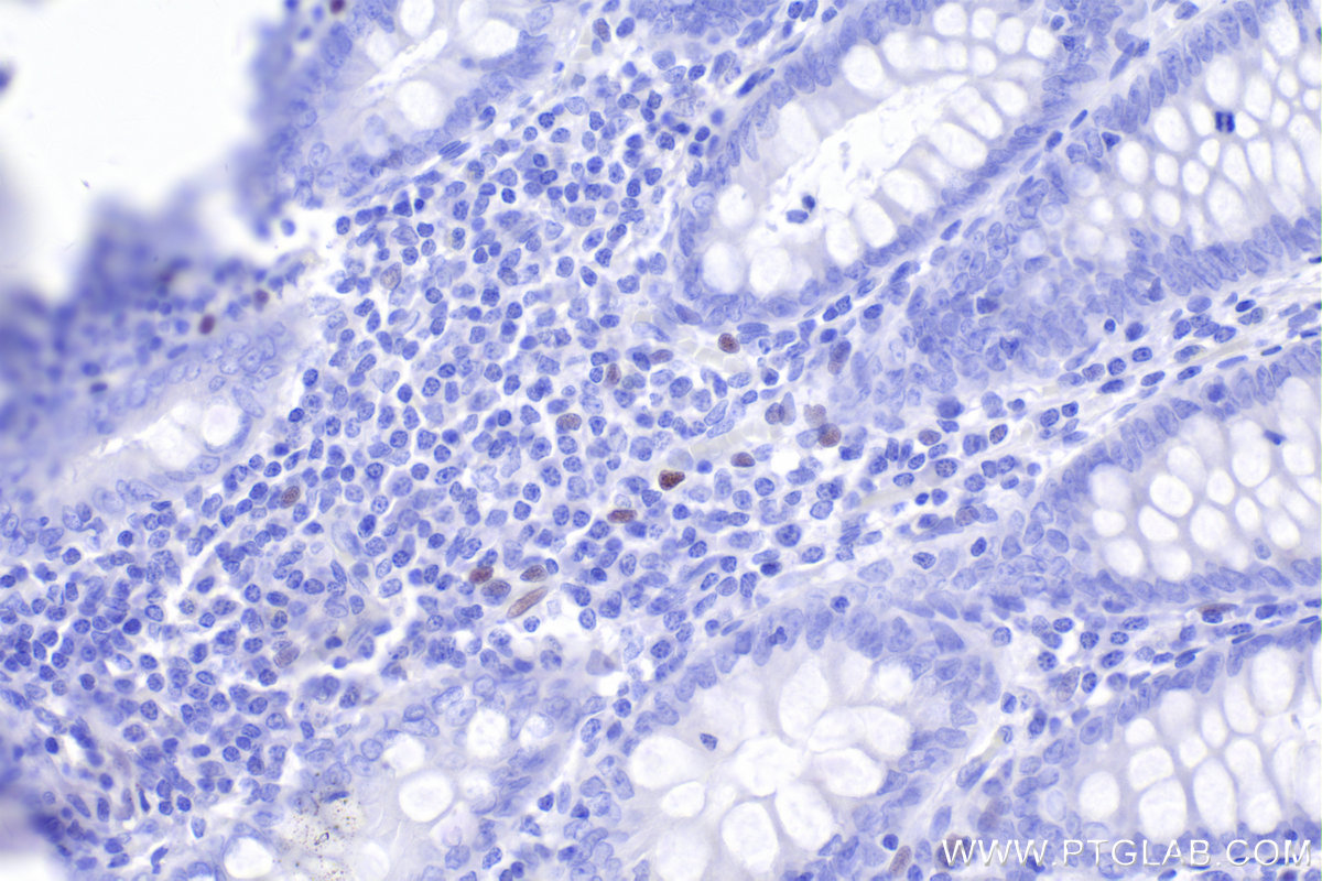 Immunohistochemistry (IHC) staining of human appendicitis tissue using FOXP3 Monoclonal antibody (68803-2-Ig)