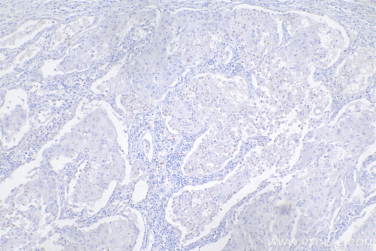 Immunohistochemistry (IHC) staining of human lung cancer tissue using FOXP3 Monoclonal antibody (68803-2-Ig)