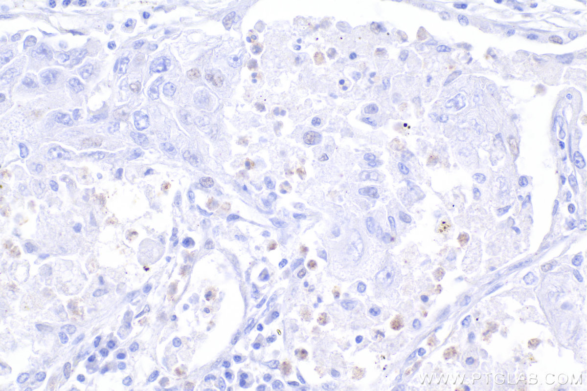 Immunohistochemistry (IHC) staining of human lung cancer tissue using FOXP3 Monoclonal antibody (68803-2-Ig)