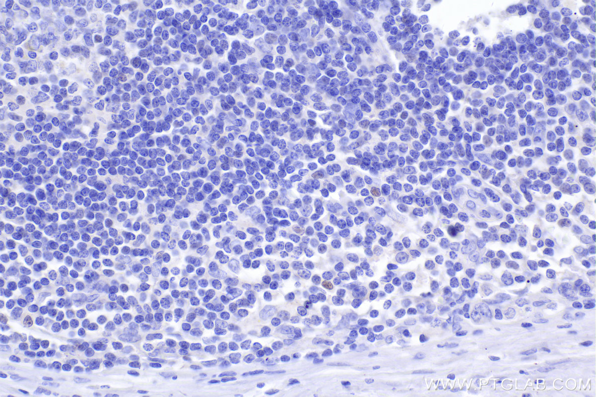 Immunohistochemistry (IHC) staining of human lymphoma tissue using FOXP3 Monoclonal antibody (68803-2-Ig)