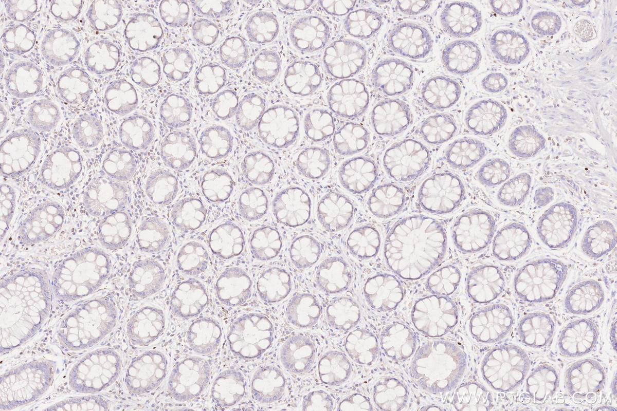 Immunohistochemistry (IHC) staining of human rectal cancer tissue using FOXP3 Monoclonal antibody (68803-2-Ig)