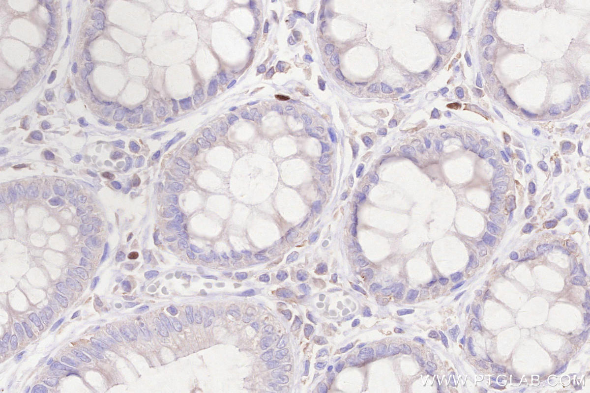 Immunohistochemistry (IHC) staining of human rectal cancer tissue using FOXP3 Monoclonal antibody (68803-2-Ig)