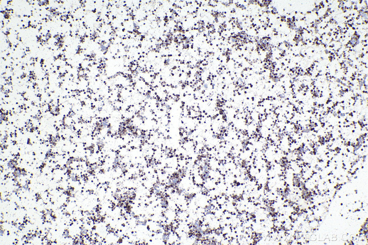 Immunohistochemistry (IHC) staining of MJ cells using FOXP3 Monoclonal antibody (68803-2-Ig)