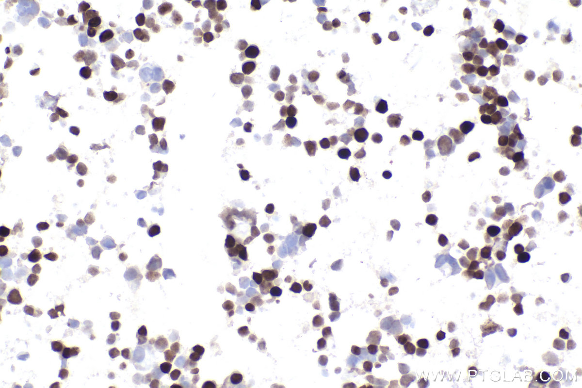 Immunohistochemistry (IHC) staining of MJ cells using FOXP3 Monoclonal antibody (68803-2-Ig)