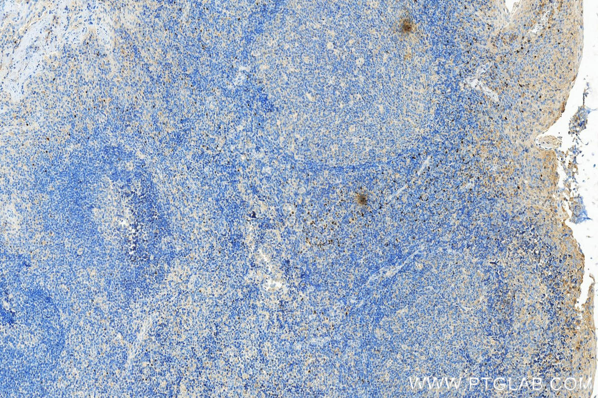 Immunohistochemistry (IHC) staining of human tonsillitis tissue using FOXP3 Monoclonal antibody (68803-2-Ig)