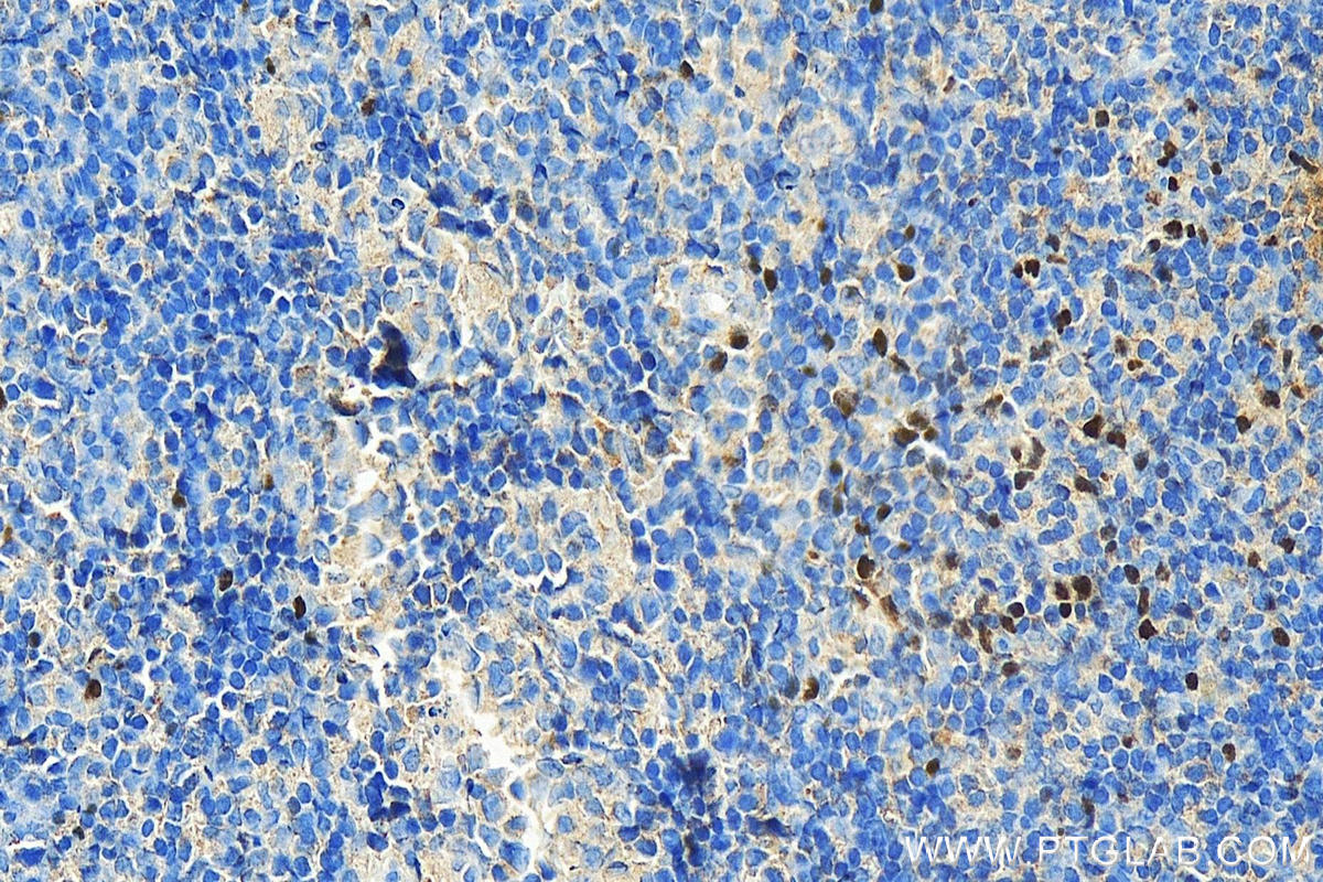 Immunohistochemistry (IHC) staining of human tonsillitis tissue using FOXP3 Monoclonal antibody (68803-2-Ig)