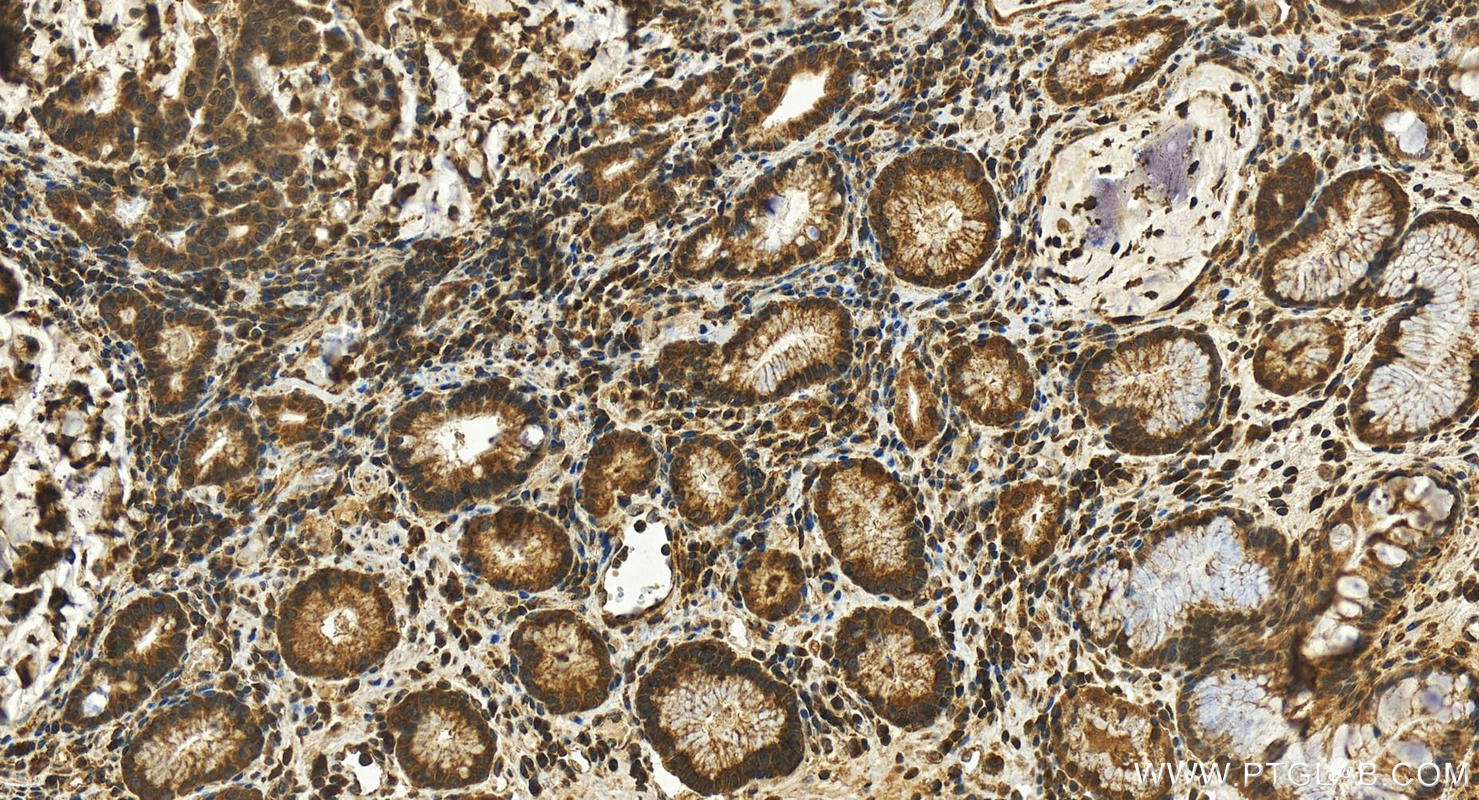 Immunohistochemistry (IHC) staining of human stomach cancer tissue using FOXQ1 Polyclonal antibody (23718-1-AP)