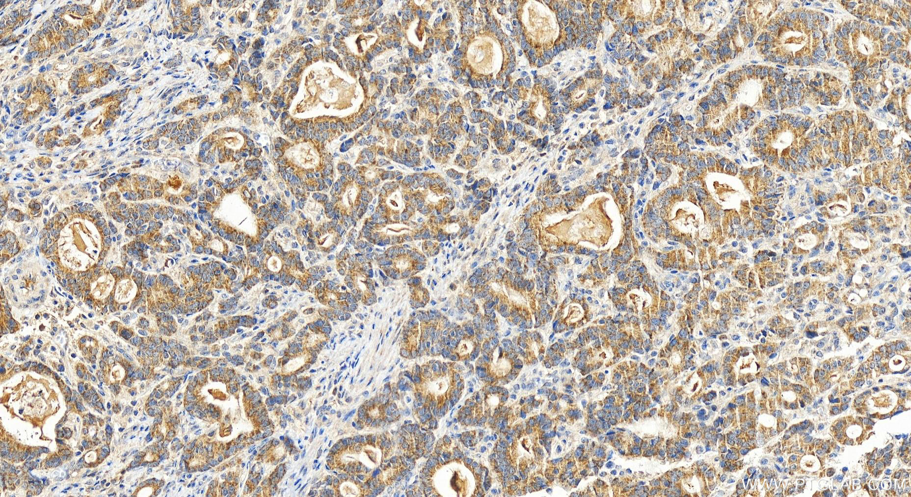 Immunohistochemistry (IHC) staining of human stomach cancer tissue using FUNDC2 Polyclonal antibody (19832-1-AP)