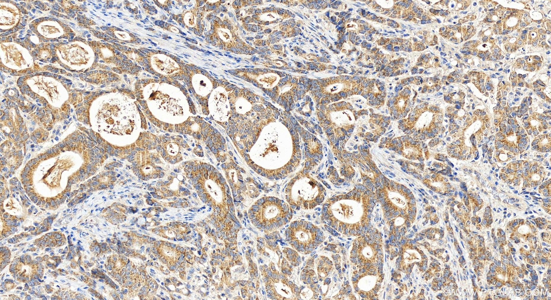 Immunohistochemistry (IHC) staining of human stomach cancer tissue using FUNDC2 Polyclonal antibody (19832-1-AP)