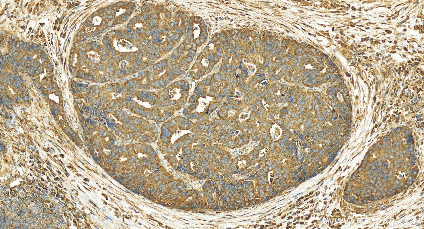 Immunohistochemistry (IHC) staining of human stomach cancer tissue using FUT4 Polyclonal antibody (19497-1-AP)