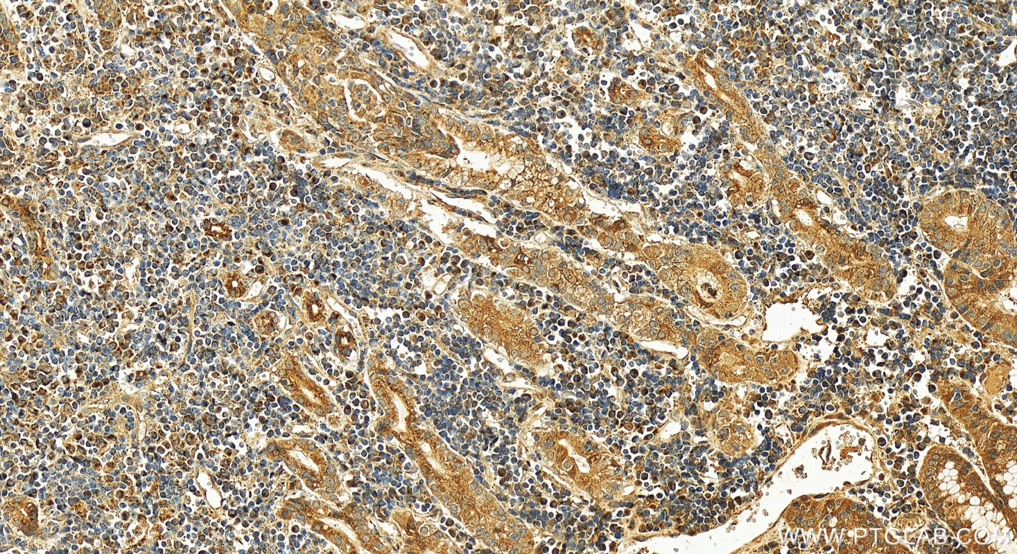 Immunohistochemistry (IHC) staining of human stomach cancer tissue using FUT8 Polyclonal antibody (12560-1-AP)