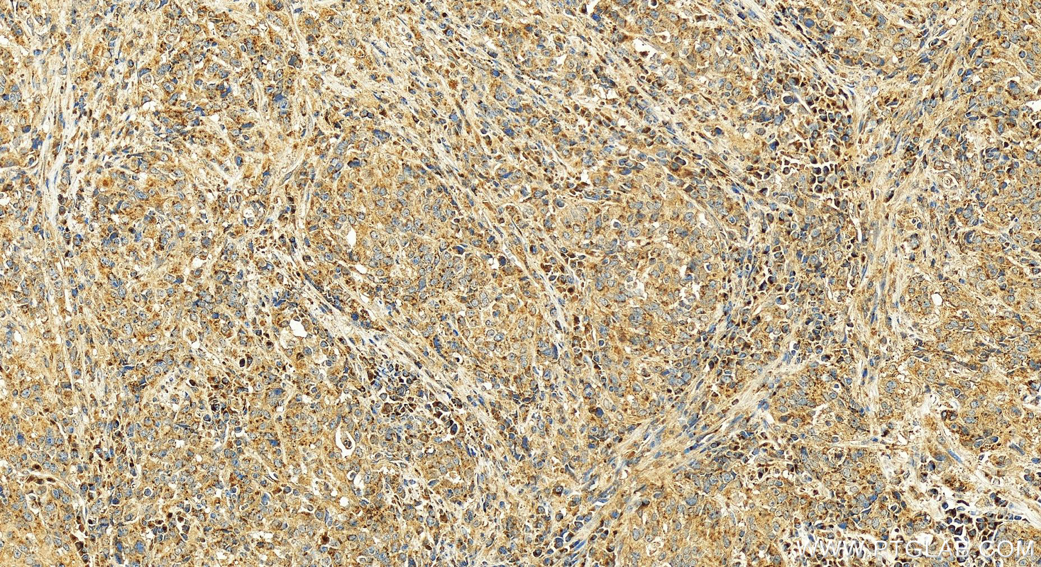 Immunohistochemistry (IHC) staining of human stomach cancer tissue using FUT8 Polyclonal antibody (12560-1-AP)