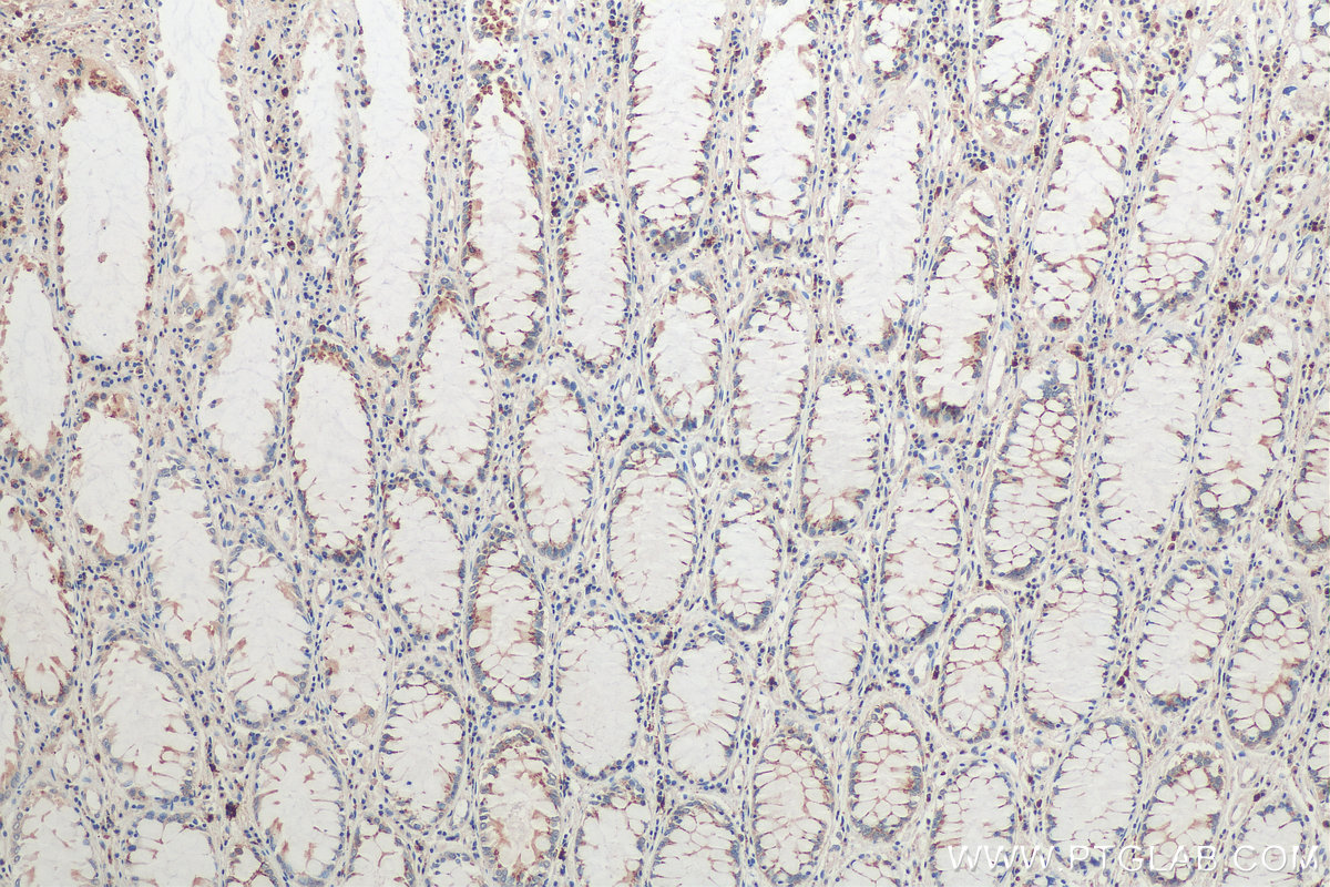 Immunohistochemistry (IHC) staining of human colon cancer tissue using FUT8 Monoclonal antibody (66118-1-Ig)