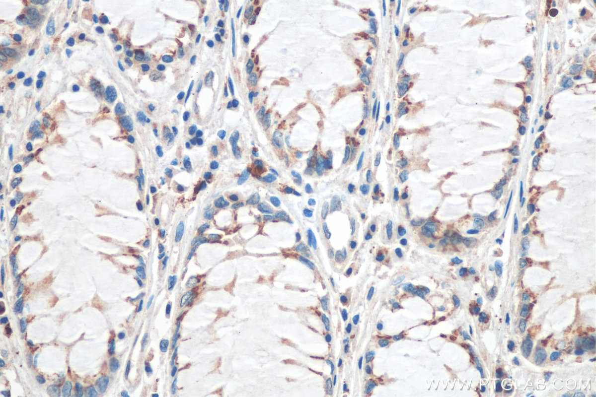Immunohistochemistry (IHC) staining of human colon cancer tissue using FUT8 Monoclonal antibody (66118-1-Ig)