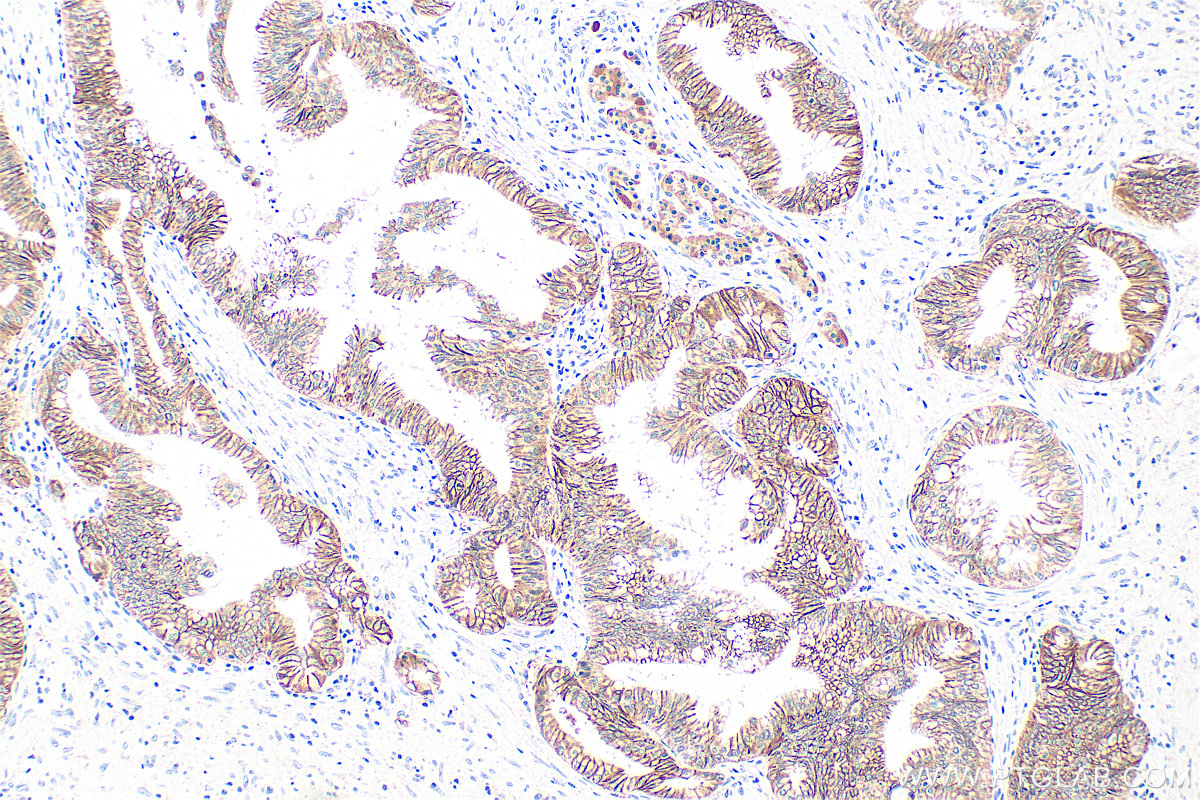 Immunohistochemistry (IHC) staining of human pancreas cancer tissue using FXYD3 Polyclonal antibody (15853-1-AP)