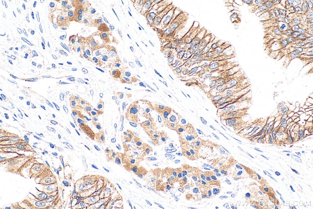 Immunohistochemistry (IHC) staining of human pancreas cancer tissue using FXYD3 Polyclonal antibody (15853-1-AP)