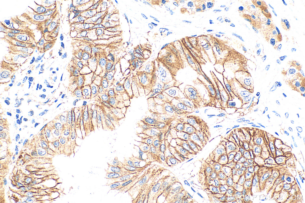 Immunohistochemistry (IHC) staining of human pancreas cancer tissue using FXYD3 Polyclonal antibody (15853-1-AP)