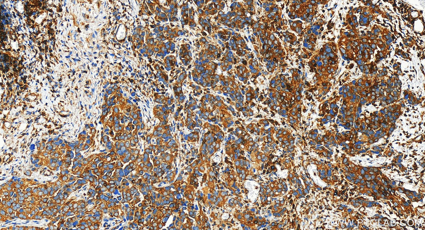 Immunohistochemistry (IHC) staining of human ovary cancer tissue using FYB Polyclonal antibody (31553-1-AP)