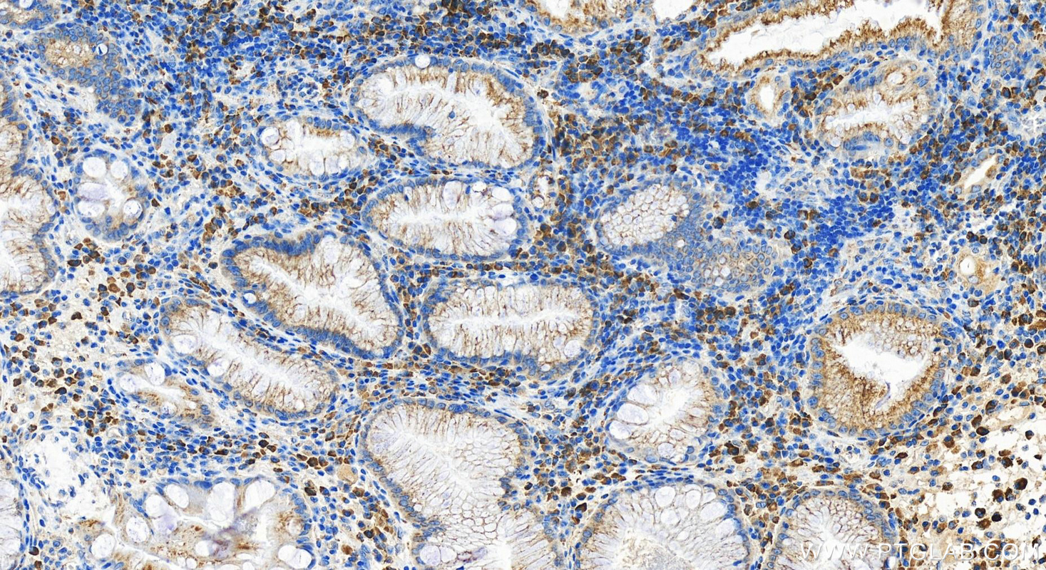 Immunohistochemistry (IHC) staining of human stomach cancer tissue using Frizzled 5 Polyclonal antibody (21519-1-AP)