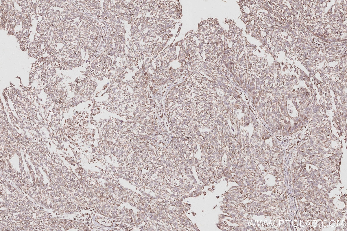 Immunohistochemistry (IHC) staining of human ovary cancer tissue using FZR1/Cdh1 Polyclonal antibody (16368-1-AP)