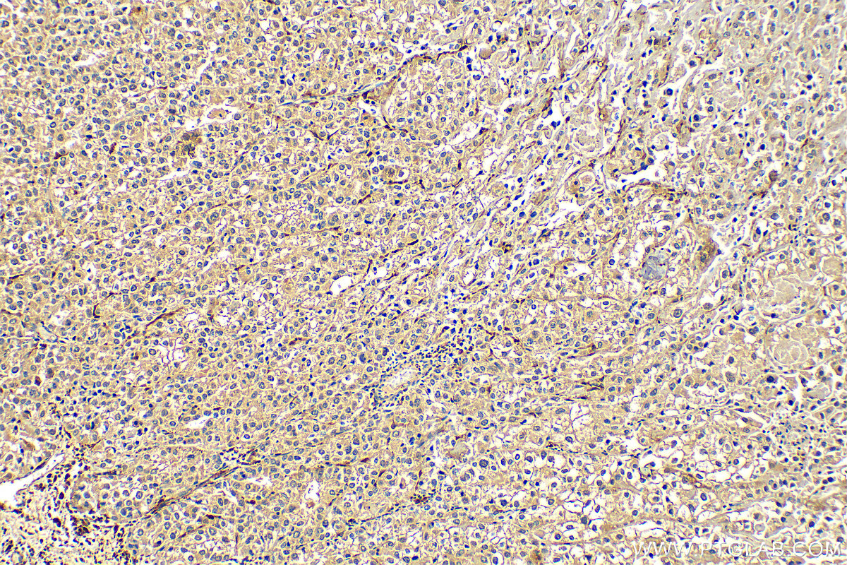 Immunohistochemistry (IHC) staining of human endometrial cancer tissue using Factor XIIIa Monoclonal antibody (66325-1-Ig)