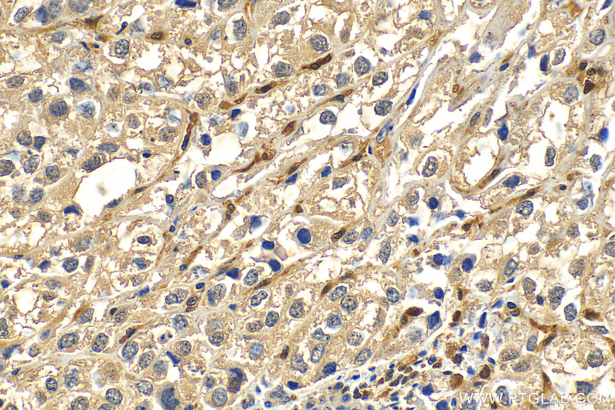 Immunohistochemistry (IHC) staining of human endometrial cancer tissue using Factor XIIIa Monoclonal antibody (66325-1-Ig)