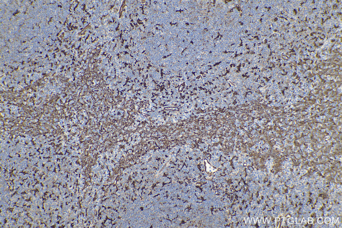 Immunohistochemistry (IHC) staining of human tonsillitis tissue using Fascin Monoclonal antibody (66321-1-Ig)