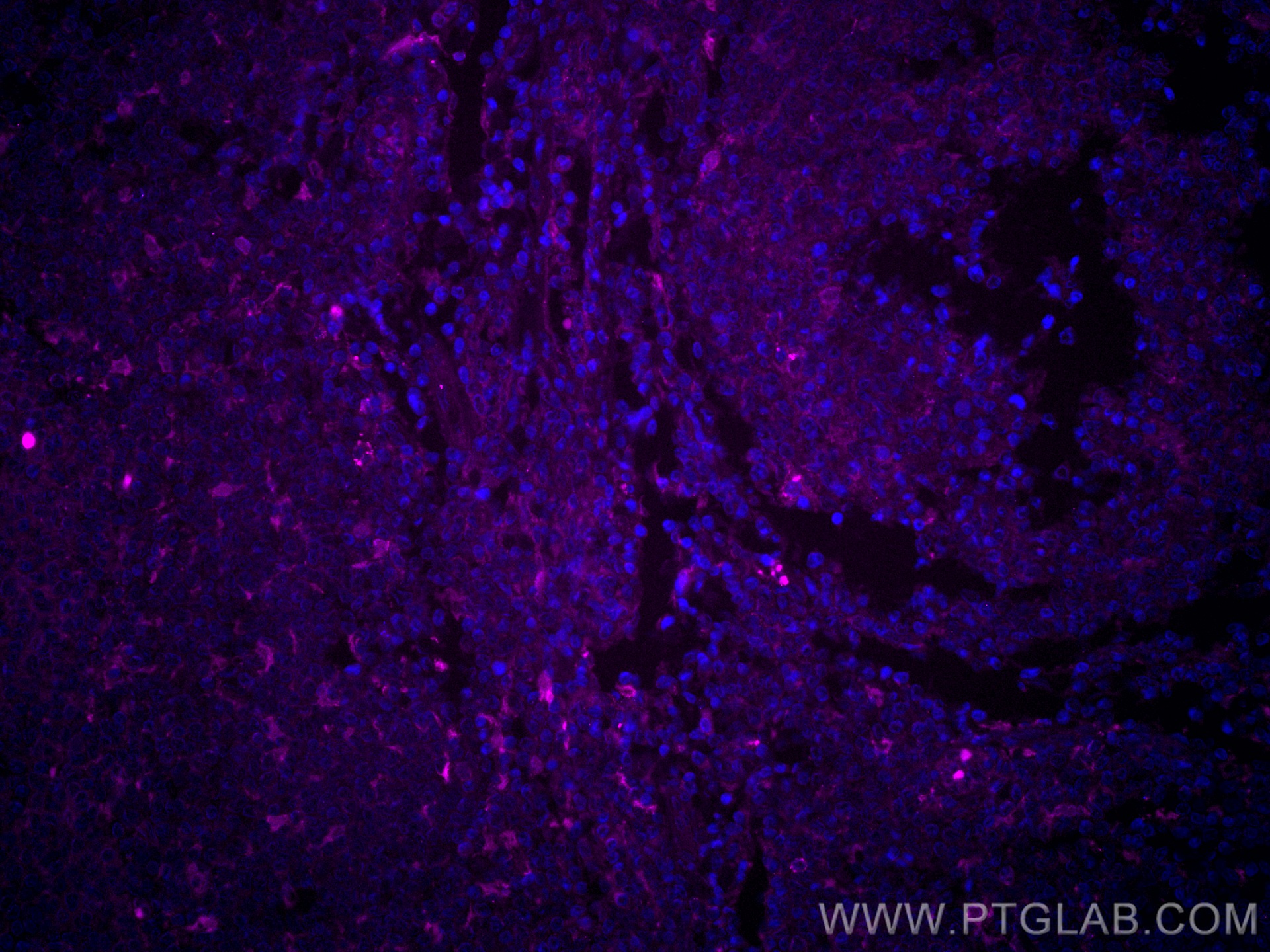Immunofluorescence (IF) / fluorescent staining of human tonsillitis tissue using CoraLite® Plus 647-conjugated Fascin Monoclonal an (CL647-66321)