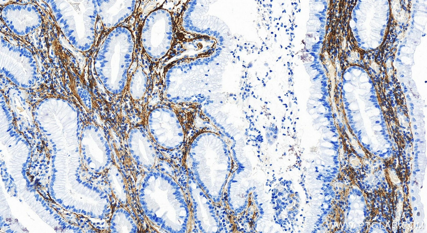 Immunohistochemistry (IHC) staining of human stomach cancer tissue using Fibrillin 1  Recombinant antibody (83836-4-RR)