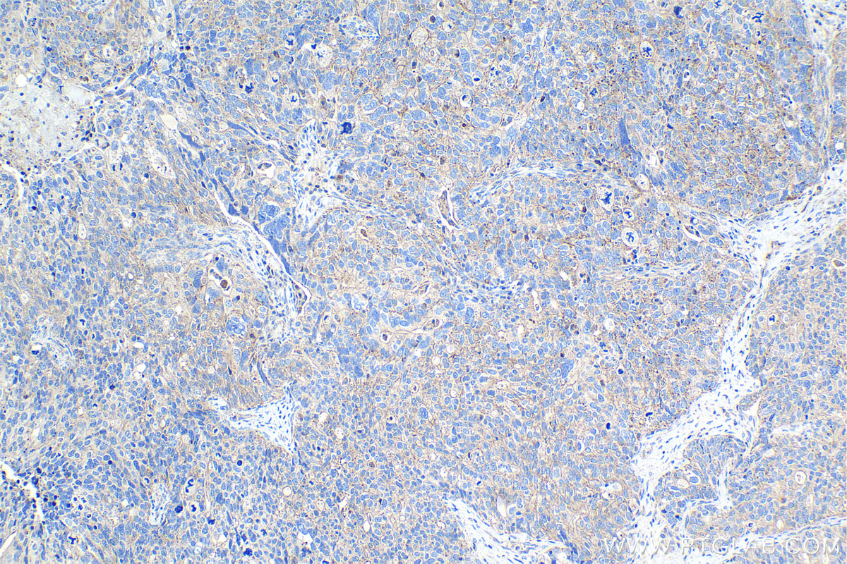 Immunohistochemistry (IHC) staining of human ovary tumor tissue using Flotillin 1 Monoclonal antibody (67968-1-Ig)