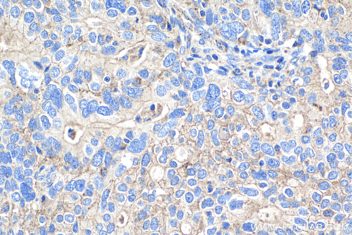 Immunohistochemistry (IHC) staining of human ovary tumor tissue using Flotillin 1 Monoclonal antibody (67968-1-Ig)