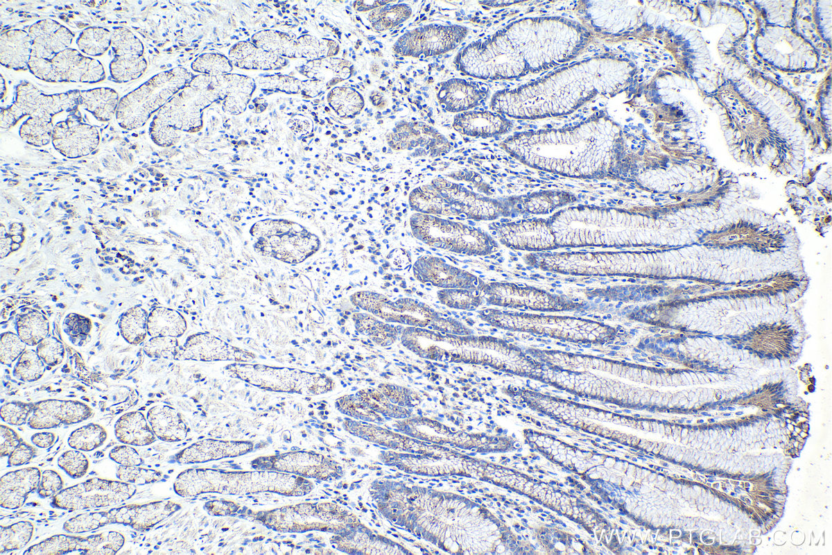 Immunohistochemistry (IHC) staining of human stomach cancer tissue using Flotillin 1 Monoclonal antibody (67968-1-Ig)