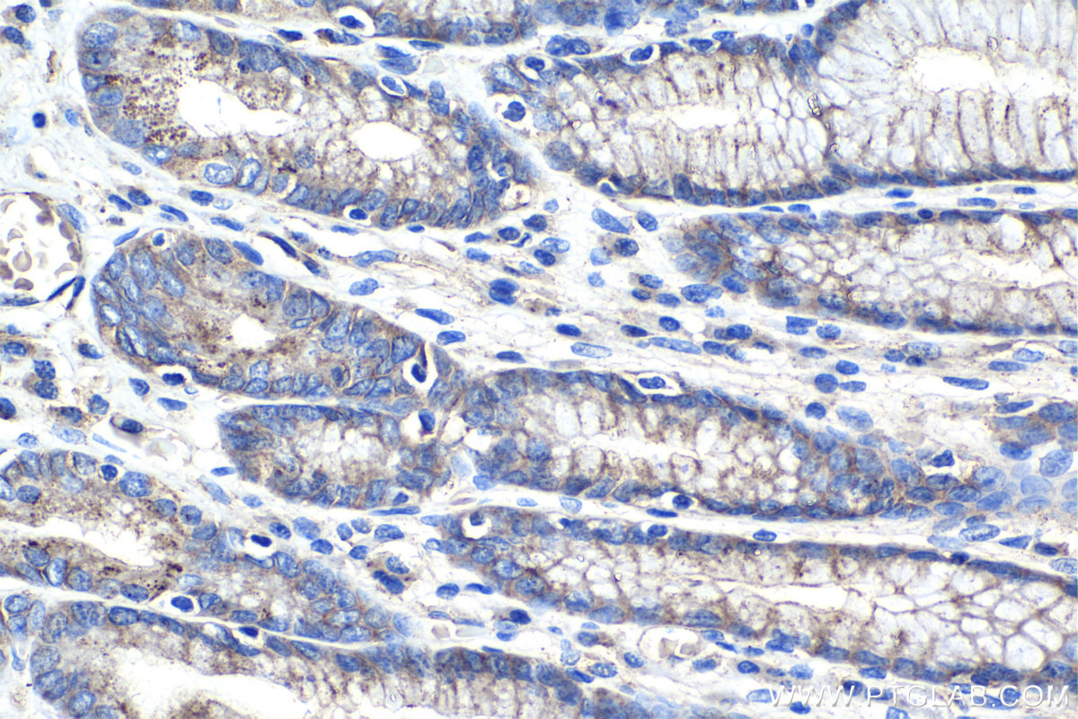 Immunohistochemistry (IHC) staining of human stomach cancer tissue using Flotillin 1 Monoclonal antibody (67968-1-Ig)