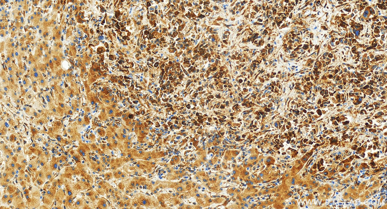 Immunohistochemistry (IHC) staining of human intrahepatic cholangiocarcinoma tissue using G3BP2 Recombinant antibody (82080-4-RR)